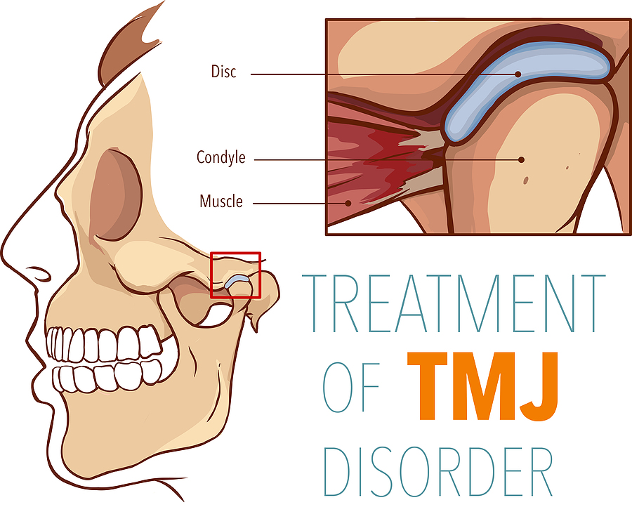 Effective TMJ Therapy for Pain Relief and Improved Function in Friendswood, TX